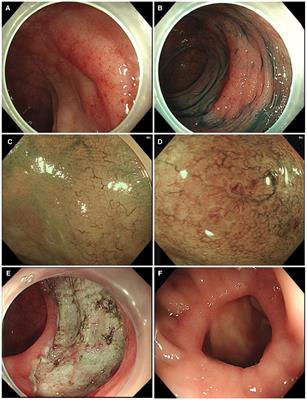 Colonic mucosa–associated lymphoid tissue lymphoma: A case report